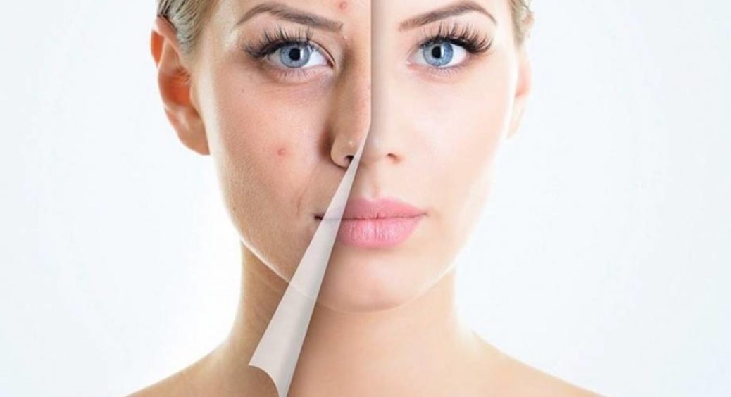 Як позбутися від прищів в домашніх умовах: перевірені методи 