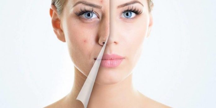 Як позбутися прищів Як позбутися прищів