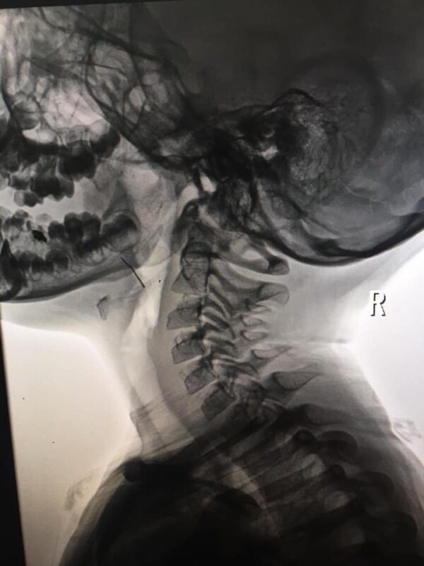 На рентгенівському знімку видно стороннє тіло в горлі