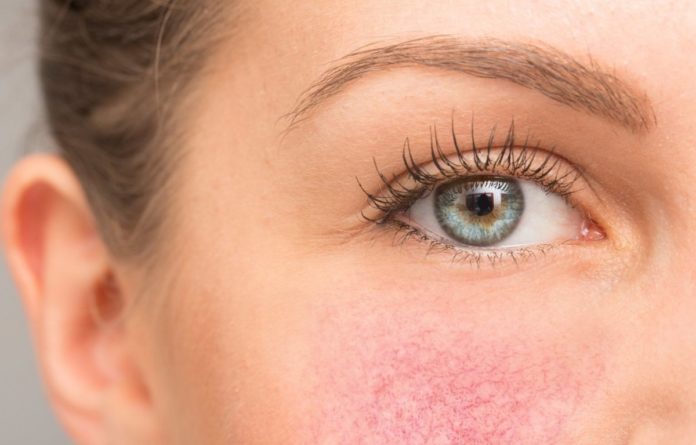 Про що говорить нездоровий рум'янець