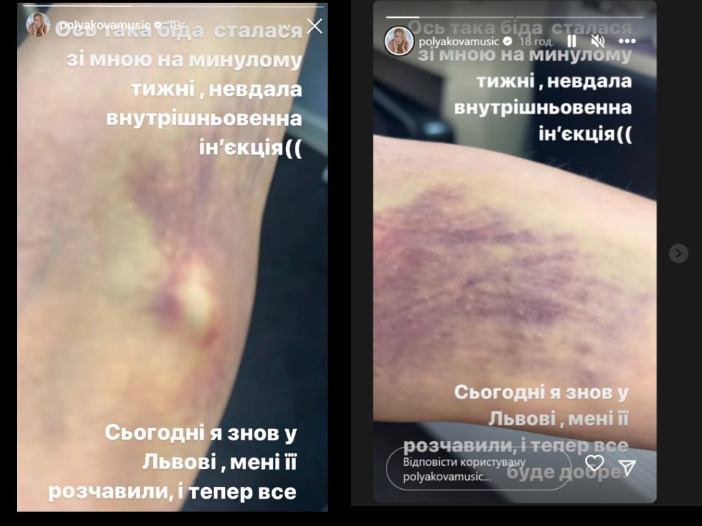 Оля Полякова показала набряклу руку після невдалої процедури