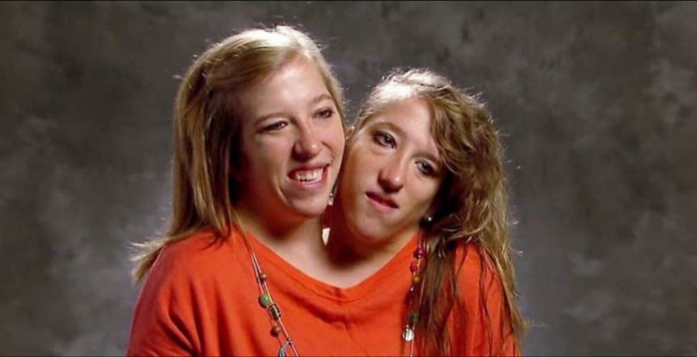 Сіамські близнючки розповіли про їх романтичні стосунки