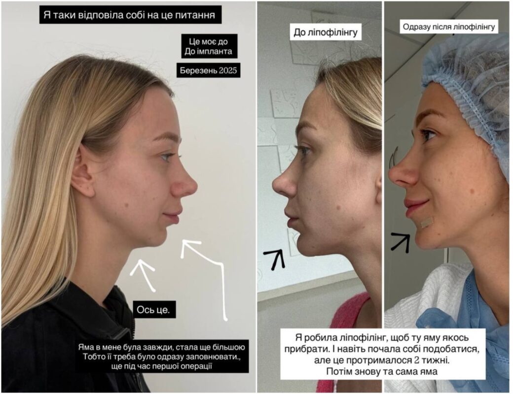 Катерина Репяхова показала, як виглядає після 4-ї пластики