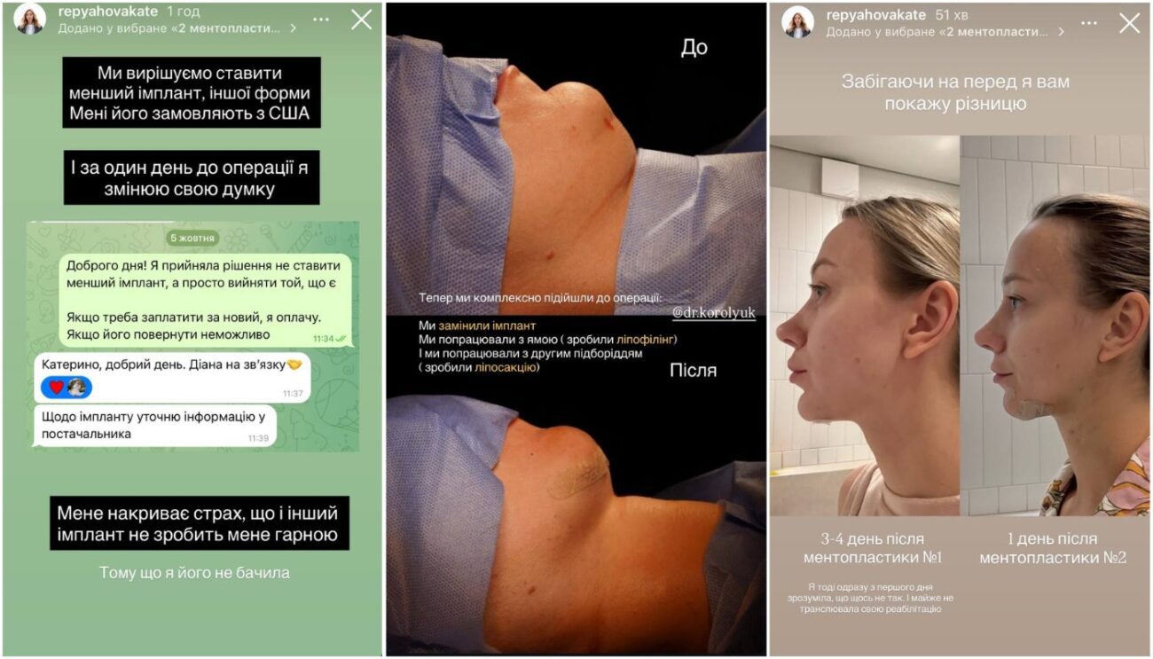 Катерина Репяхова показала, як виглядає після 4-ї пластики