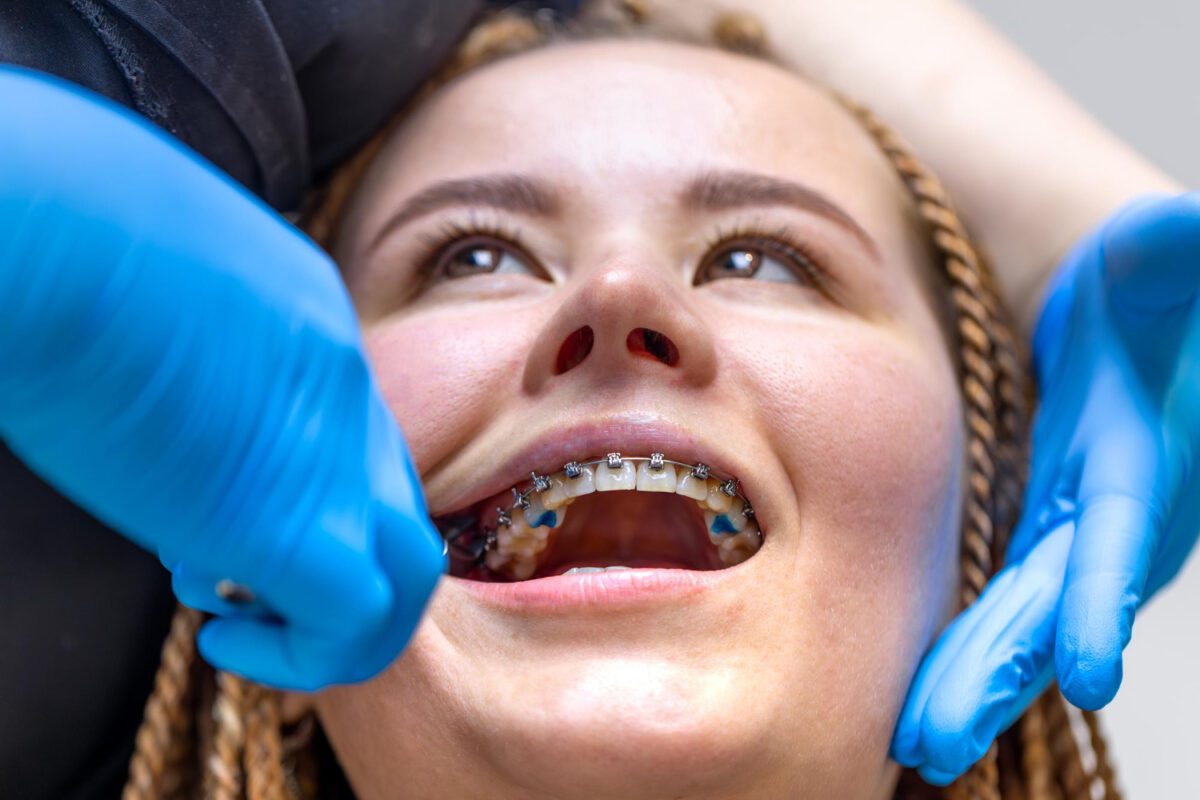 Експерти розповіли, коли потрібно видаляти зуби мудрості і ставити брекети